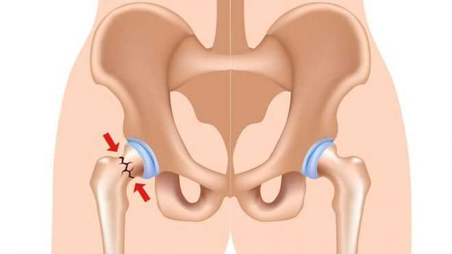 Перелом шейки бедра