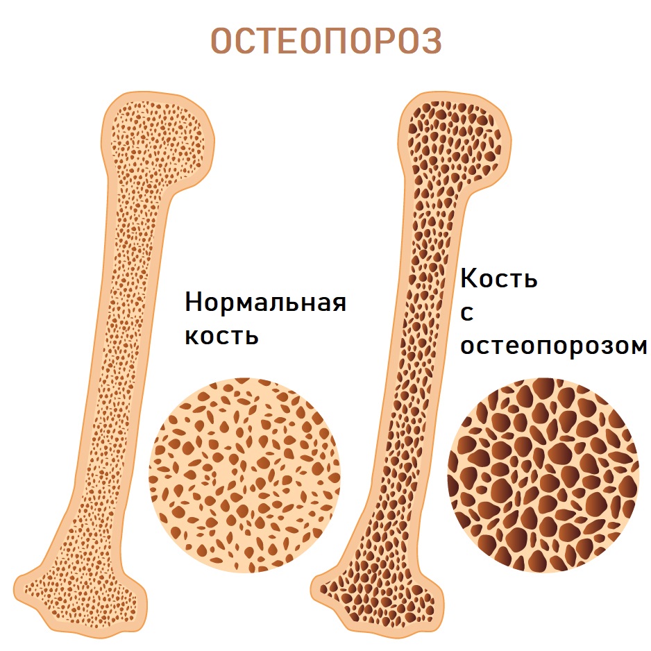 Остеопороз: симптомы и лечение у мужчин и женщин ✓ Методы профилактики